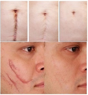 疤痕灵疤痕膏疤痕修复手术刀疤凹凸男女通用痘印痘疤正品